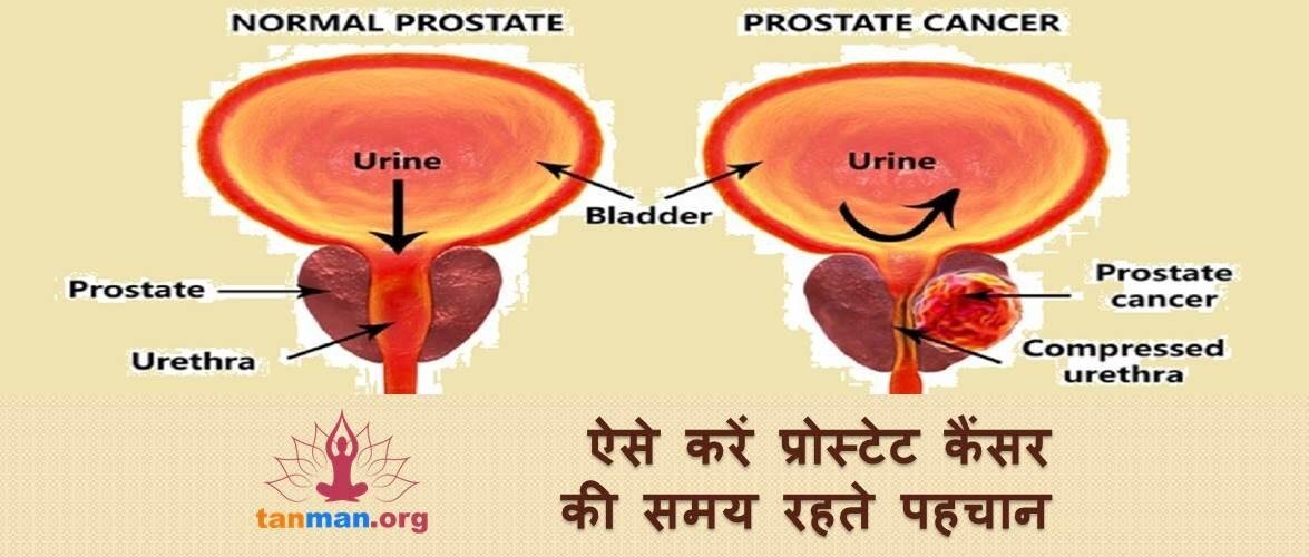 ऐसे करें प्रोस्टेट कैंसर की जल्द पहचान, ताकि नहीं जाए किसी की जान