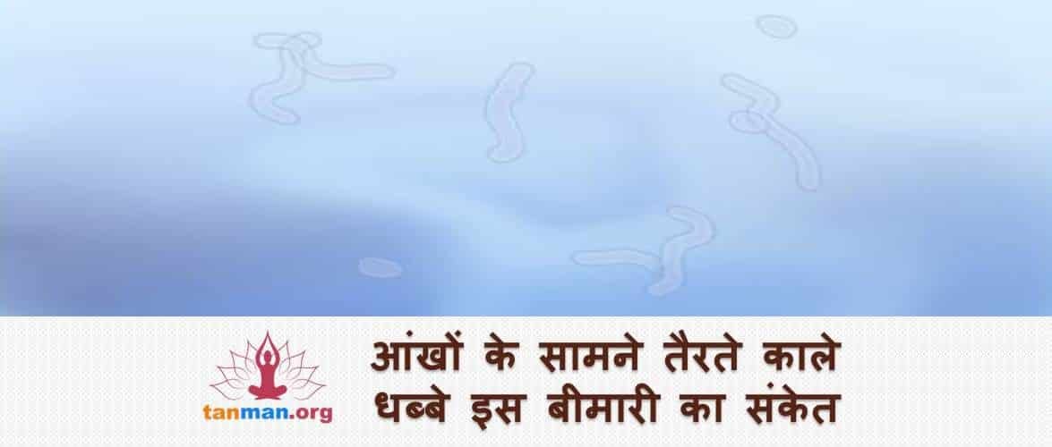 आंखों की इस खतरनाक बीमारी की ओर इशारा करते हैं नजरों के सामने तैरते काले धब्बे