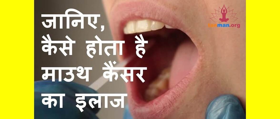 मुंह के कैंसर की सर्जरी के बारे में सब कुछ