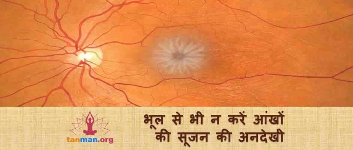 भूल से भी न करें आंखों की सूजन की अनदेखी, वरना छिन सकती है रोशनी