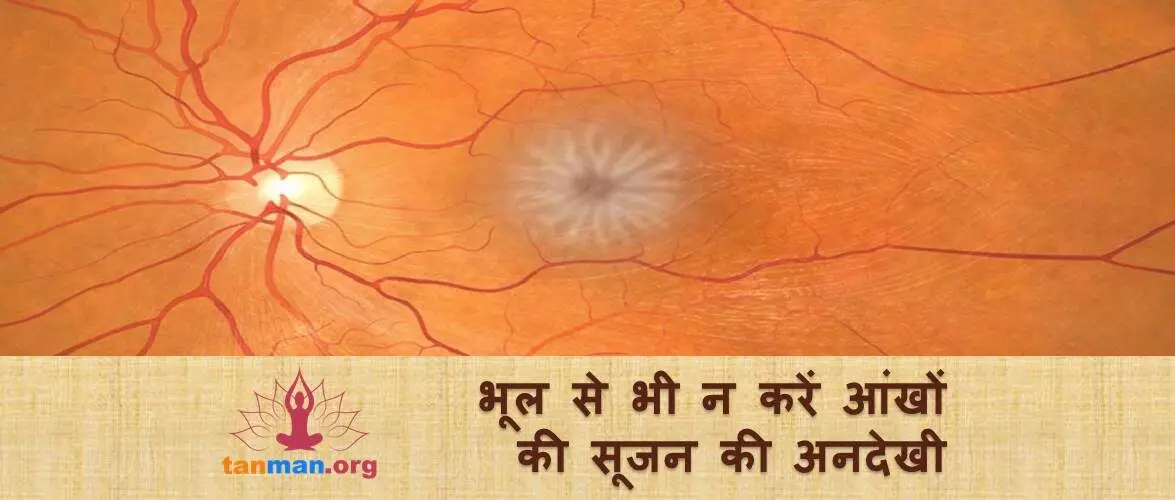 भूल से भी न करें आंखों की सूजन की अनदेखी, वरना छिन सकती है रोशनी