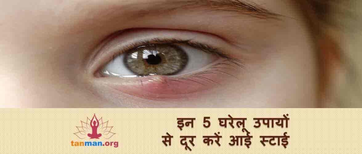 इन 5 घरेलू उपायों से दूर करें आई स्टाई