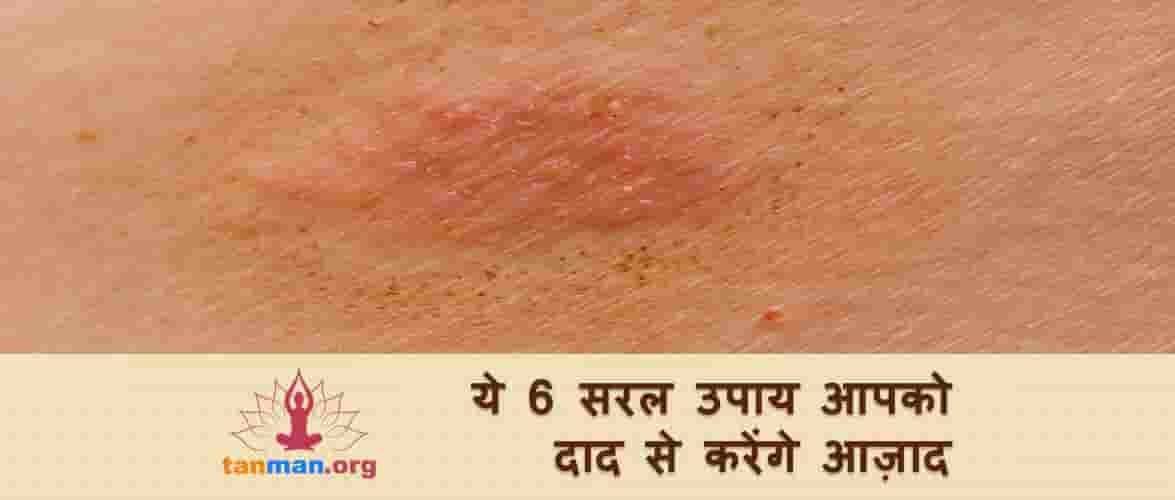 ये 6 घरेलू उपाय आपको दाद से करेंगे आज़ाद