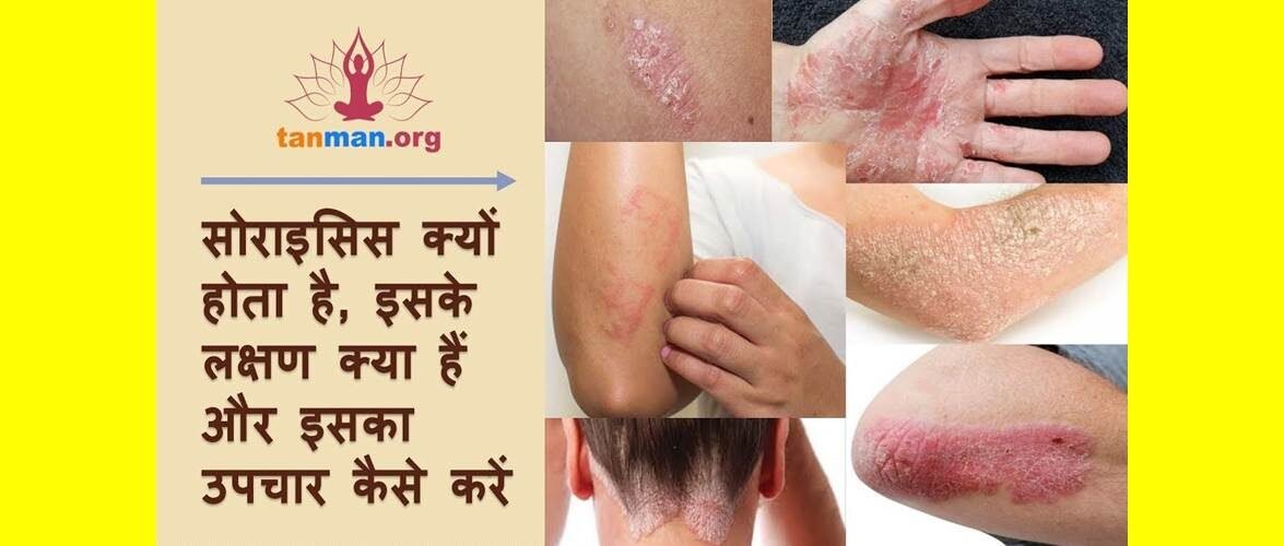 सोरायसिस को जड़ से खत्म करने के टॉप 11 घरेलू उपचार
