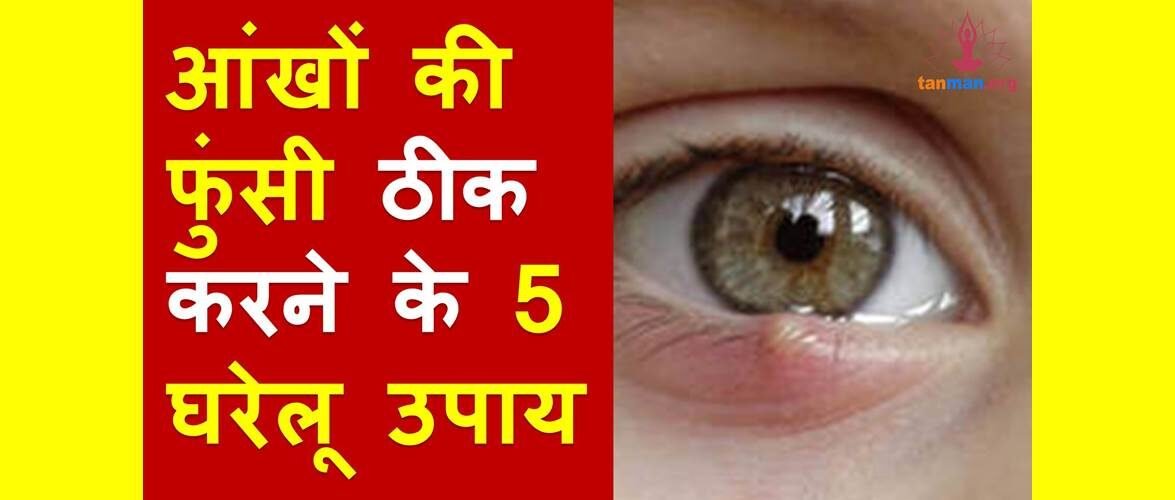 इन 5 असरदार घरेलू उपायों से ठीक करें आंखों की फुंसी