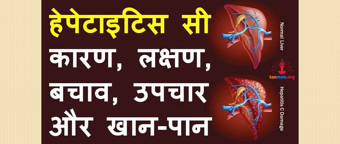 हेपेटाइटिस सी के कारण, लक्षण, बचाव, उपचार और खान-पान