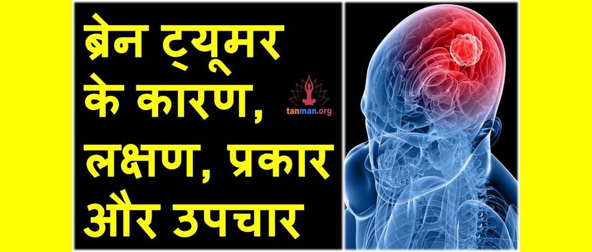 ब्रेन ट्यूमर के कारण, लक्षण, प्रकार और उपचार