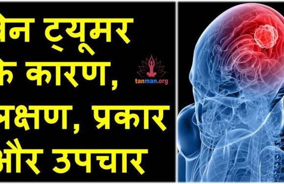 ब्रेन ट्यूमर के कारण, लक्षण, प्रकार और उपचार