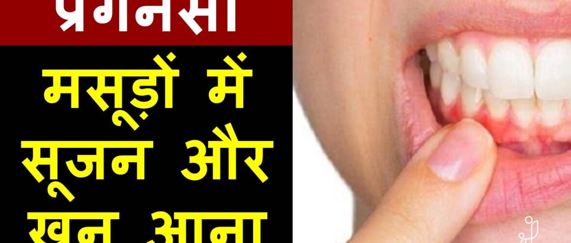 मसूड़ों से खून रोकने के 8 असरदार घरेलू तरीके