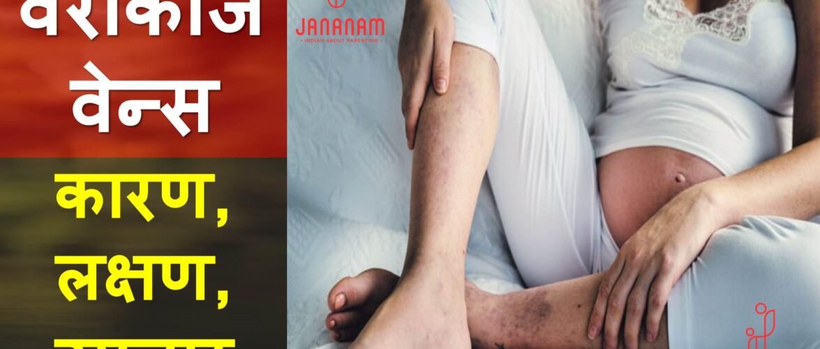 वेरीकोज वेन का इलाज कैसे करें?