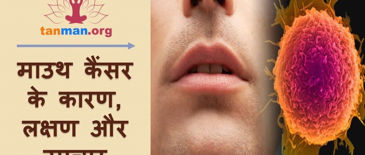 मुंह के कैंसर के शुरुआती लक्षण, कारण और इलाज